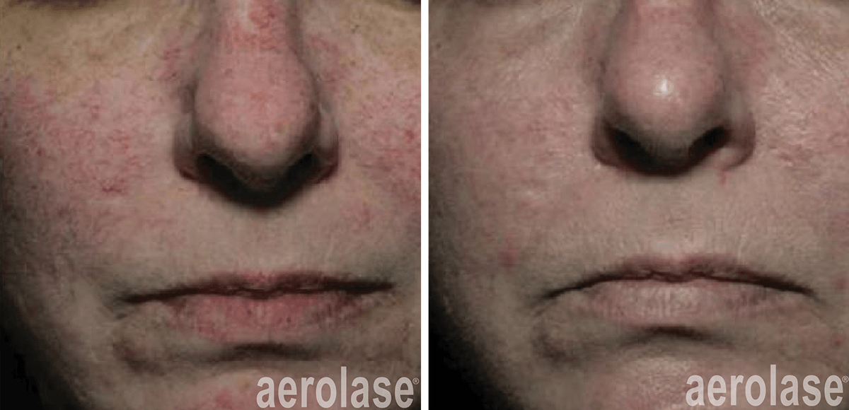 aerolase-NeoSkin Rosacea and Veins - After 2 Treatments - David Goldberg MD