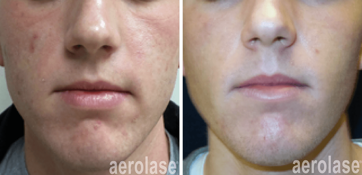 aerolase-kevin-pinski-acne-skin-rejuvenation