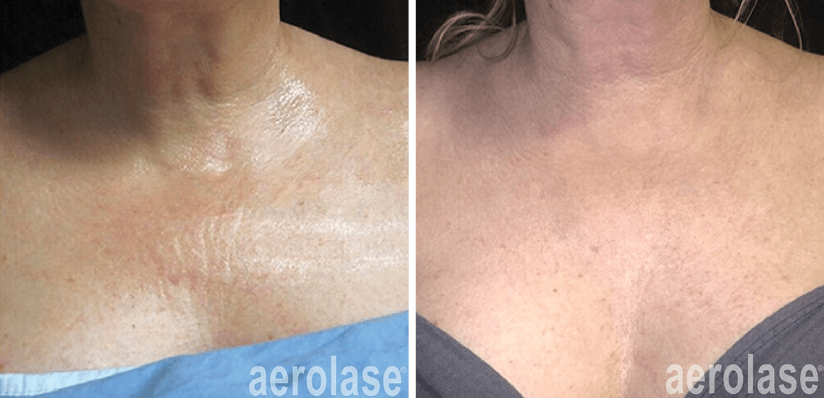 aerolase-neoskin-skin-rejuvenation-after-4-treatments-jason-emer